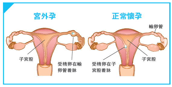 17oi302